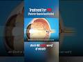Treatment of PCO after Cataract Surgery #youtubeshorts #cataractsurgery #factshindi #eyehealth