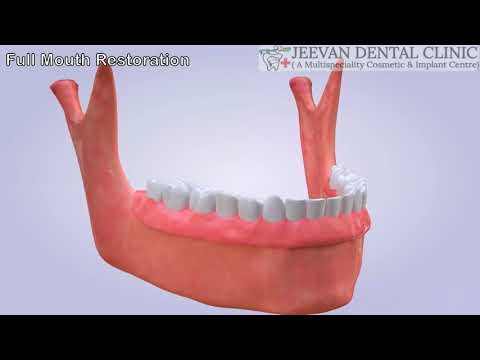 full-mouth-rehabilitation-,-replacement-of-missing-teeth-with-dental-implant-,-jeevan-dental-clinic