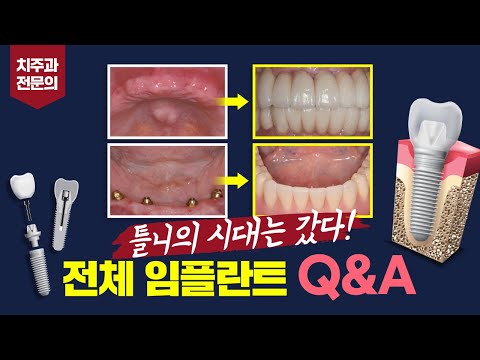   전악임플란트 전후 치주과 전문의가 알려주는 명쾌한 Q A A Case Study And Q A On Transmission Implants