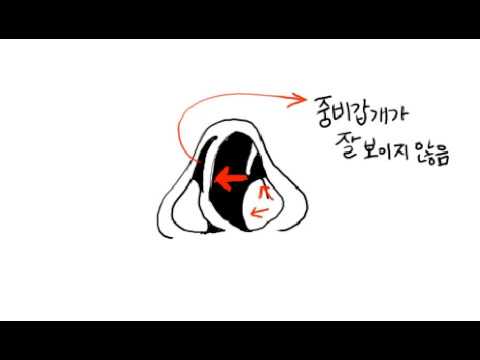 비중격만곡증 septoplasty