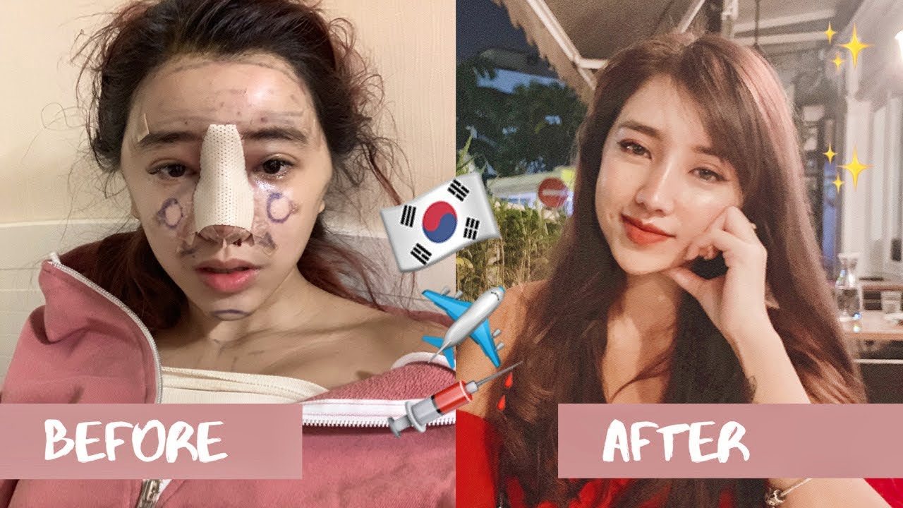 My Plastic Surgery In Korea Part 1 Cinderella Clinic Breast Nose And Fat Grafting Surgery Youtube
