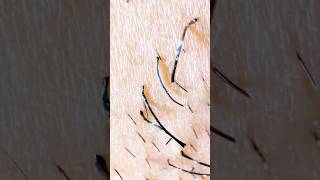 Satisfying hair plucks #hairremoval