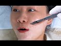 ASMR | Women Face Shaving | Dermaplaning Treatment