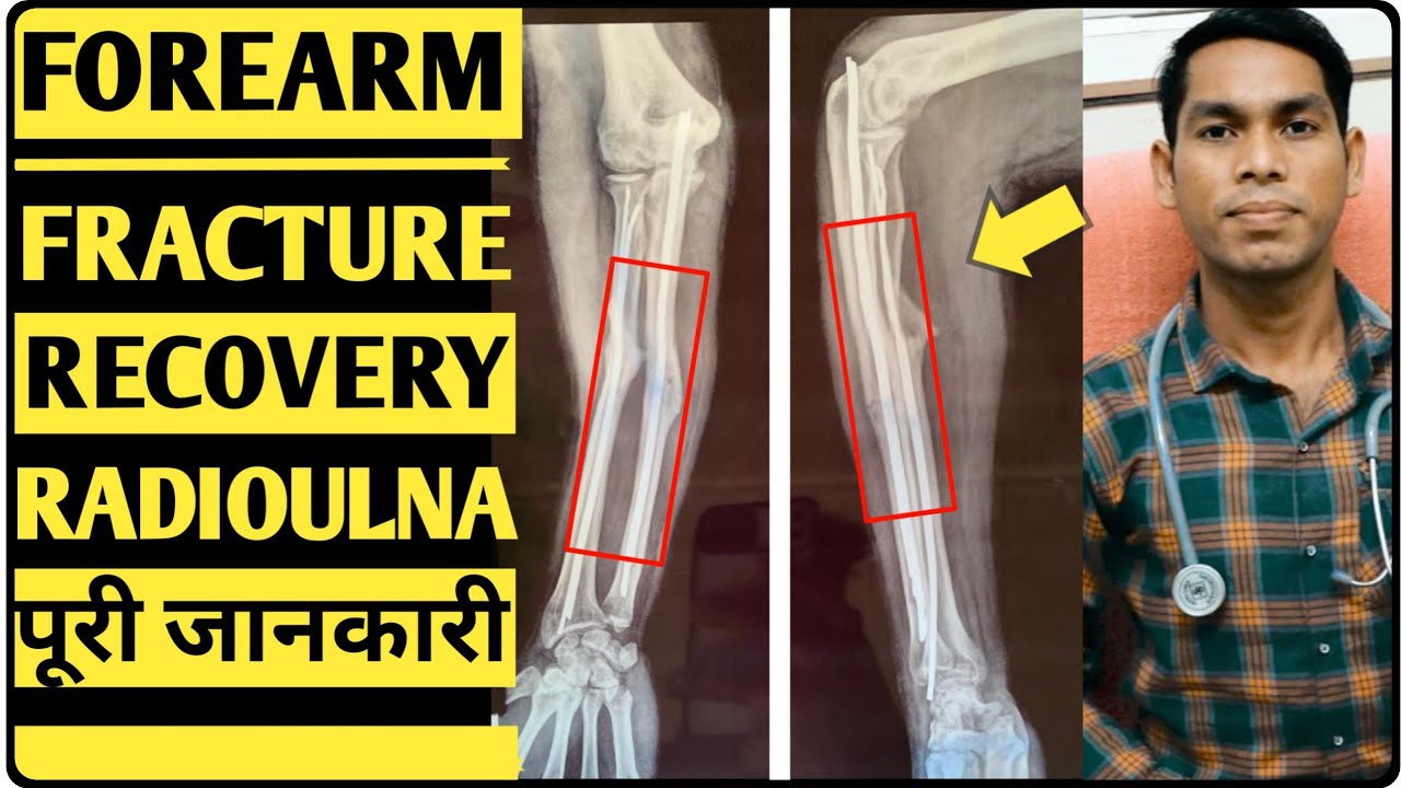 Radius🦴ulna🦴Radioulnar joint, Forearm fracture physiotherapy exercises