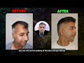 FUE Hair Transplant - 6 Months Hair Growth Results in India