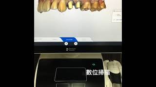 新竹牙醫峰皇牙醫診所 根管治療搭配全瓷冠