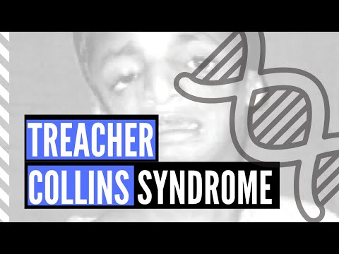 Treacher-Collins Syndrome - Pathology, Diagnosis, Clinical Presentation, and Treatment