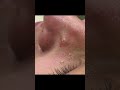 Milia Extraction on the Nose Gets SATISFYING #shorts #skincare #pimplepopper