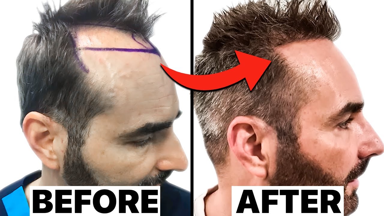 My SHOCKING 18 Months Hair Transplant Results | Surgeon Reacts