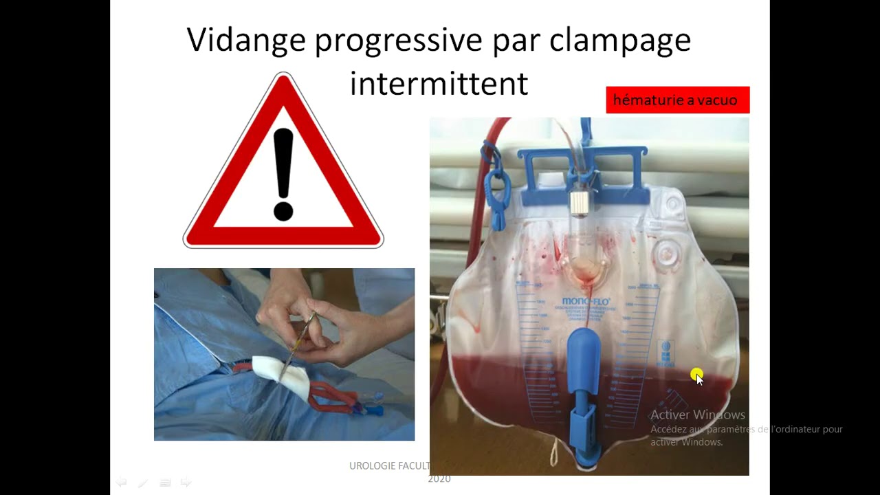 Rétention urinaire aigue Pr BENATTA M