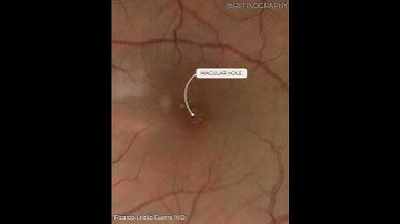 AGE-RELATED MACULAR DEGENERATION MULTIMODAL ANALYSIS For more images like this visit www.retinograph