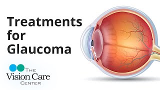 Dr. Weyer Discusses Treatments for Glaucoma