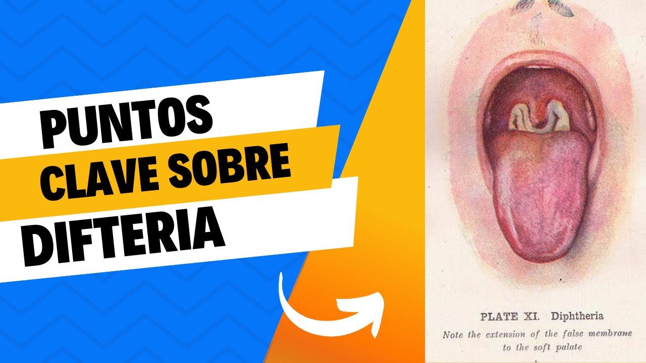 DIFTERIA ❗️❗️❗️ ENARM