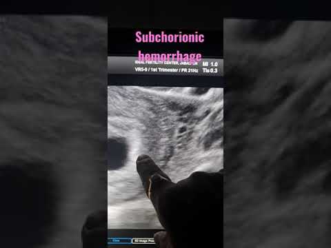 Video: Wo ist das subchoriale Hämatom?