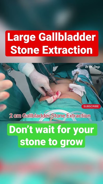 largest-gallbladder-stone-extraction-viral-viralvideo-shorts
