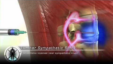 Lumbar Sympathetic Block Injection Procedure Animation