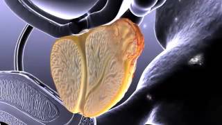 Prostate Cancer Animation