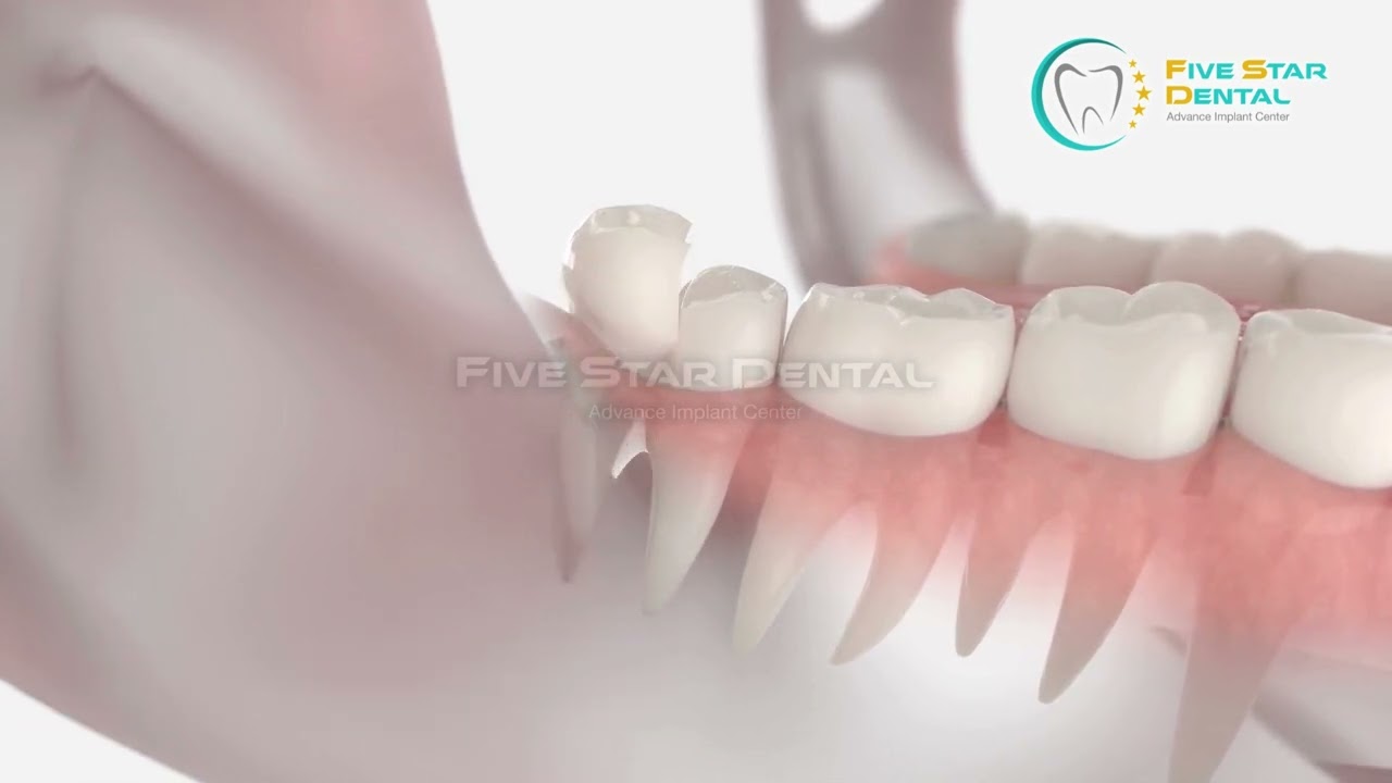 🦷 Wisdom Teeth Extraction Experts! 🦷