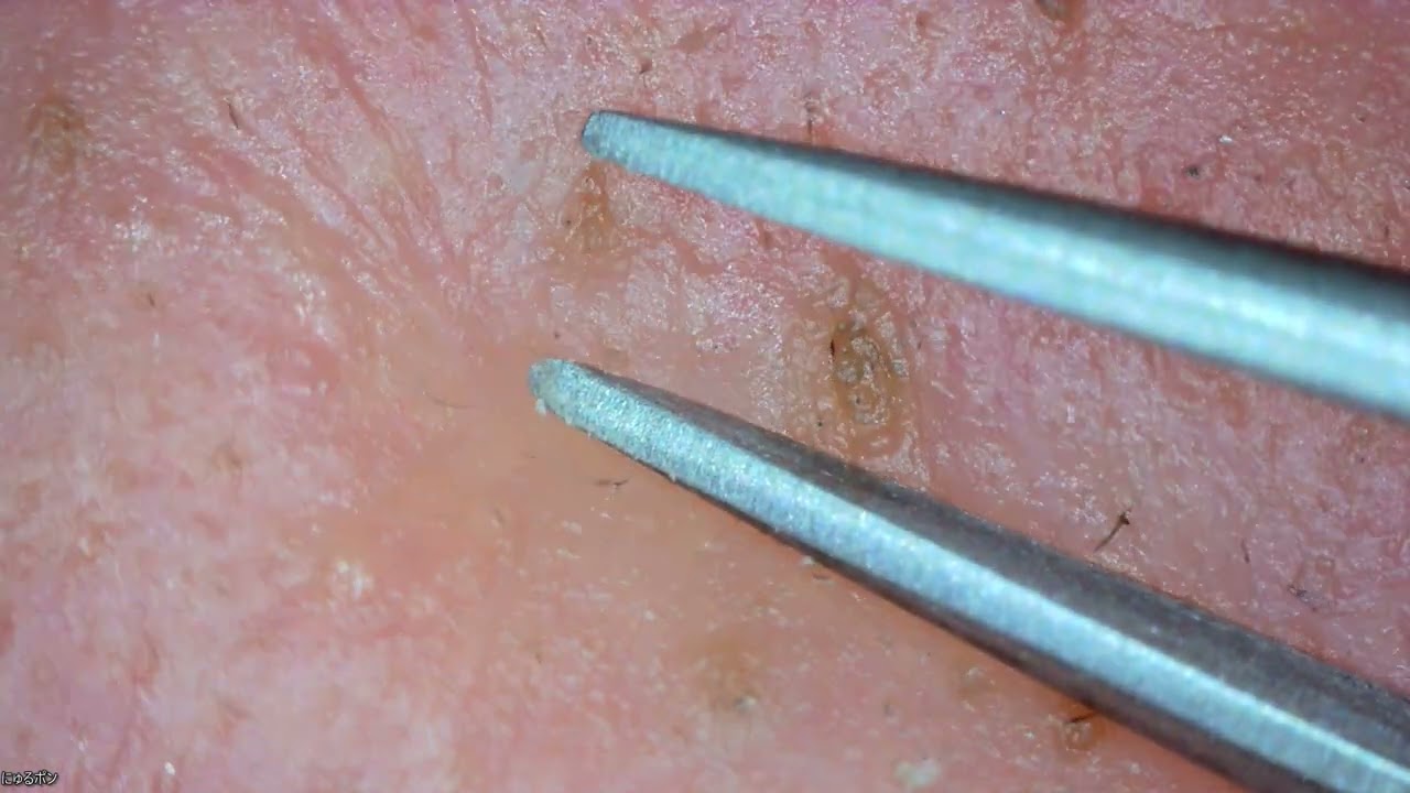 Keratin Plug Won't Come Out at Connie Acevedo blog