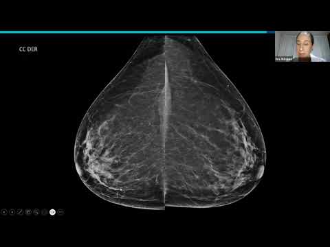 Sesión mensual de la Unidad de Imagen Mamaria, revisión de casos impartido por CT Scanner San Ángel