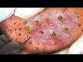 Pop a huge cystic acne  blackheads