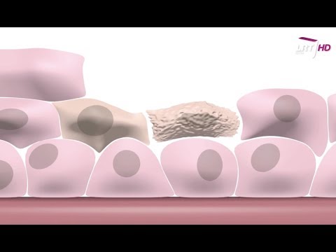 Video: Ar dirbtinis saldiklis sukelia vėžį?