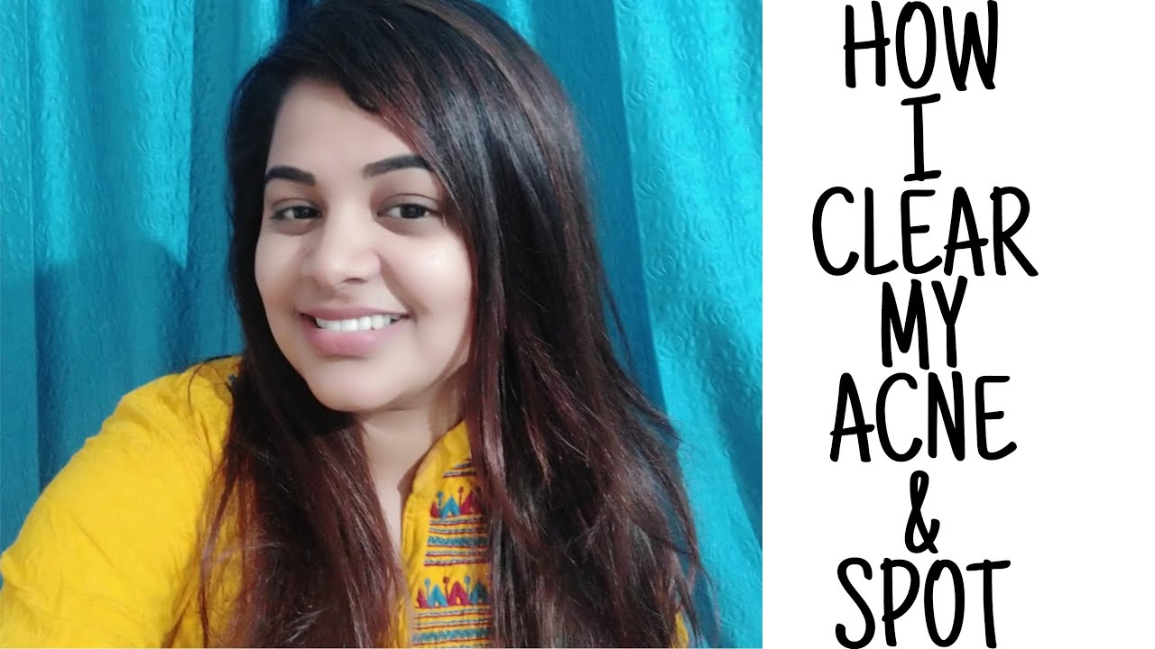 HOW I CLEAR MY ACNE & SPOT JUST IN 7 DAYS ... CAN'T BELIEVE ??? SO TRY ...
