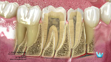 ¿Qué mata el nervio de un diente?