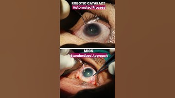 Robotic Cataract vs MICS | Step-by-Step Live Surgery