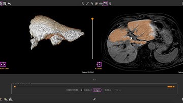 RegionGrowing for CE-MRI (EOB-Primovist)