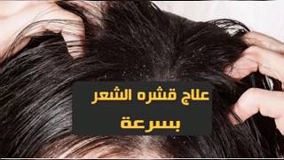 حل نهائي لتخلص من قشرة الرأس