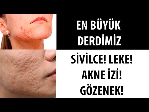 GÖZENEK KAPANIR MI, AKNE İZİ, SIVILCE, KOMEDON, ANTI-AGING...