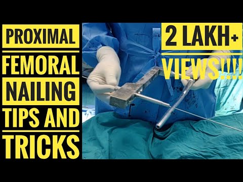 Proximal Femoral Nail (PFN) (Detailed Surgical Technique)