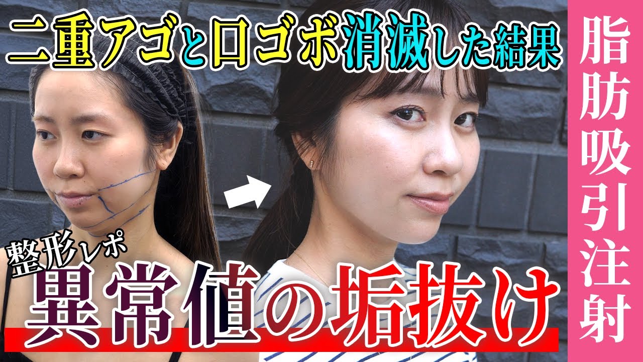 【脂肪吸引注射整形密着】安いのにここまで小顔になれる！口ゴボ解消で垢抜け成功【糸リフト・ヒアルロン酸】SBC最安値のイテウォンビューティークリニック