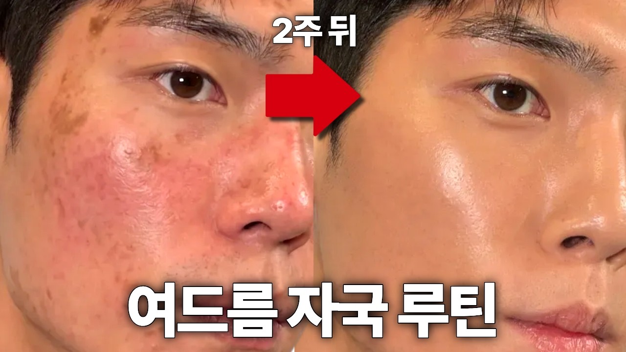 여드름 흔적, 1년갈거 딱 2주만에 이 3가지면 싹 없어집니다