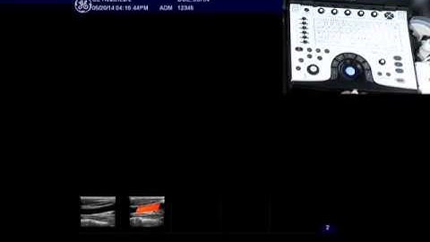 NextGen LOGIQ e: Raw Data