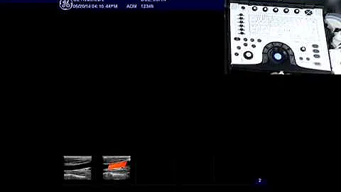 NextGen LOGIQ e: Raw Data