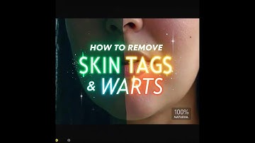 "How to Remove Skin Tags and Warts Overnight – Natural & Painless Remedies!"