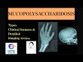 Mucopolysaccharidosis case discussion of types clinicoradiological features morquios  hurlers