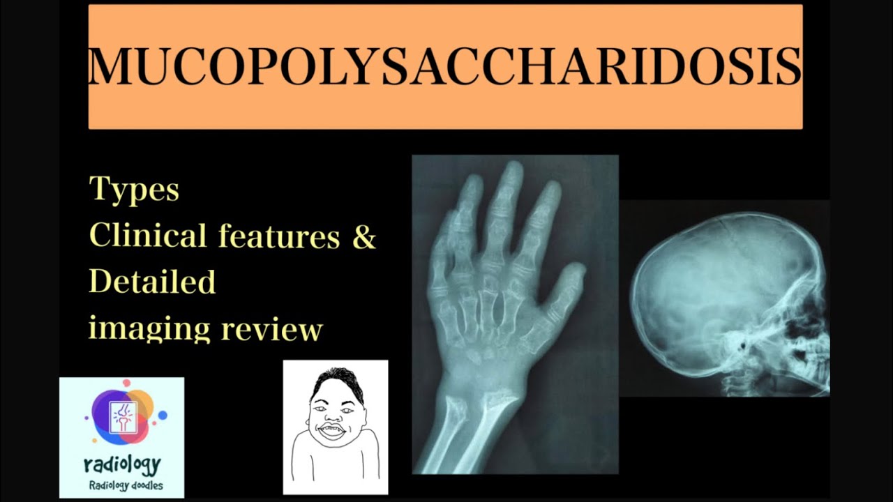 Mps Radiology MUCOPOLYSACCHARIDOSIS- Case discussion of types, clinico-radiological ...