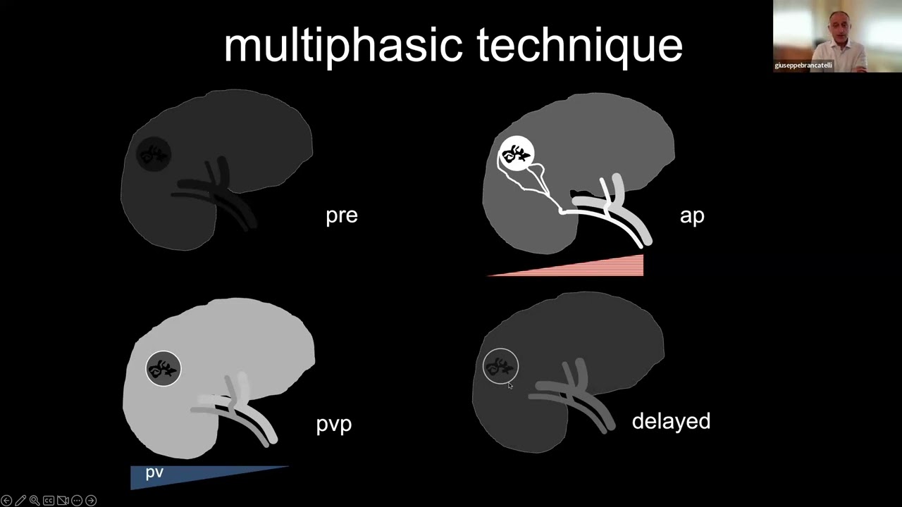 23.5) Le neoplasie epatiche -  Prof. Vanzulli e Prof. Brancatelli