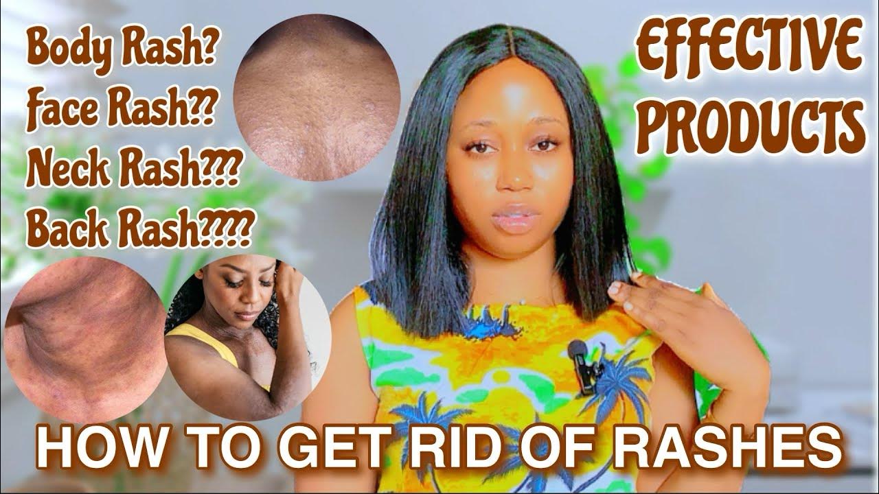 HOW TO GET RID OF RASHES Face Rashes Back Rashes+ EFFECTIVE PRODUCTS