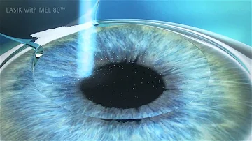 ¿Cómo saber si el colgajo LASIK se ha desplazado?