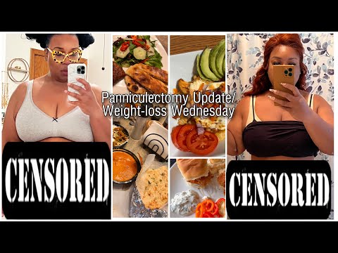 Panniculectomy Update: Before & After | 2Weeks of Vlog Footage in 1 Video!