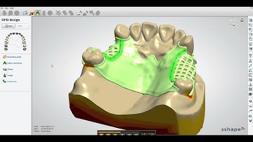 Kastle Mills 3Shape Design Video for Removable Partial RPD