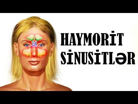 Haymorit (Sinusitlər) - Təbii Yolla Müalicə