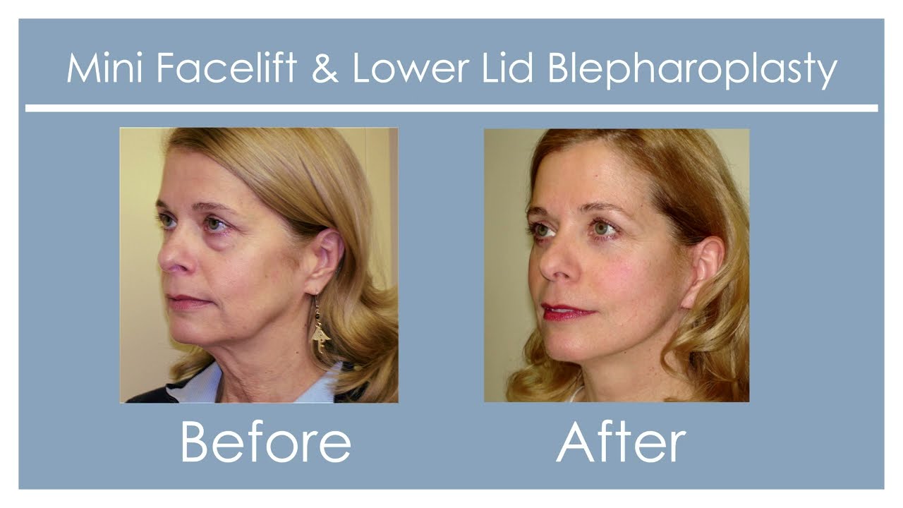 Facelift Surgery with Dr. Pontell
