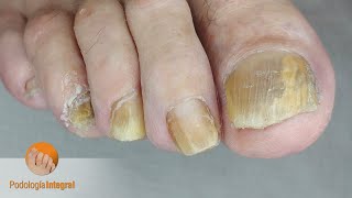 Nail mycosis (Fungal nails) #podology #asmr