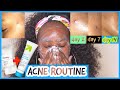 MY 10% BENZOYL PEROXIDE ACNE ROUTINE| DEALING WITH STRESSED SKIN AND POST ACNE/ BLIND PIMPLES