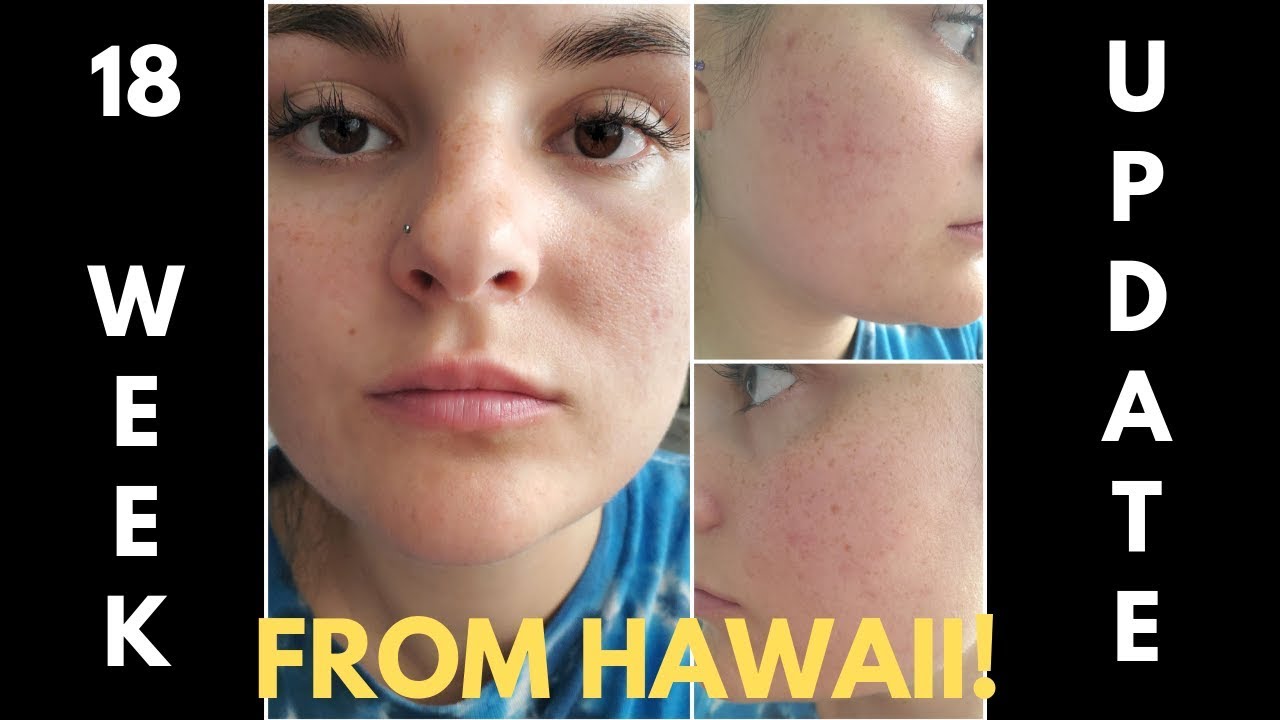Spironolactone for Acne! 18 WEEK UPDATE! (from Hawaii!) - Episode #16